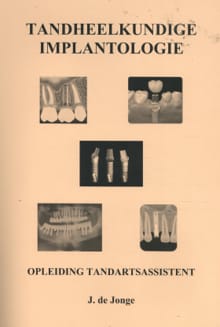 Tandheelkundige Implantologie - J. de Jonge